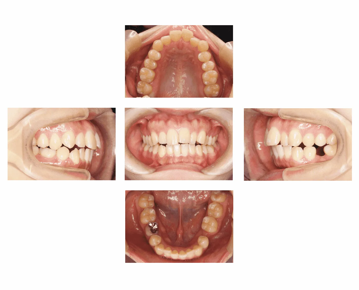 先天性欠損歯（歯が無い）の治療例 | 福岡・天神のしもだ矯正歯科 